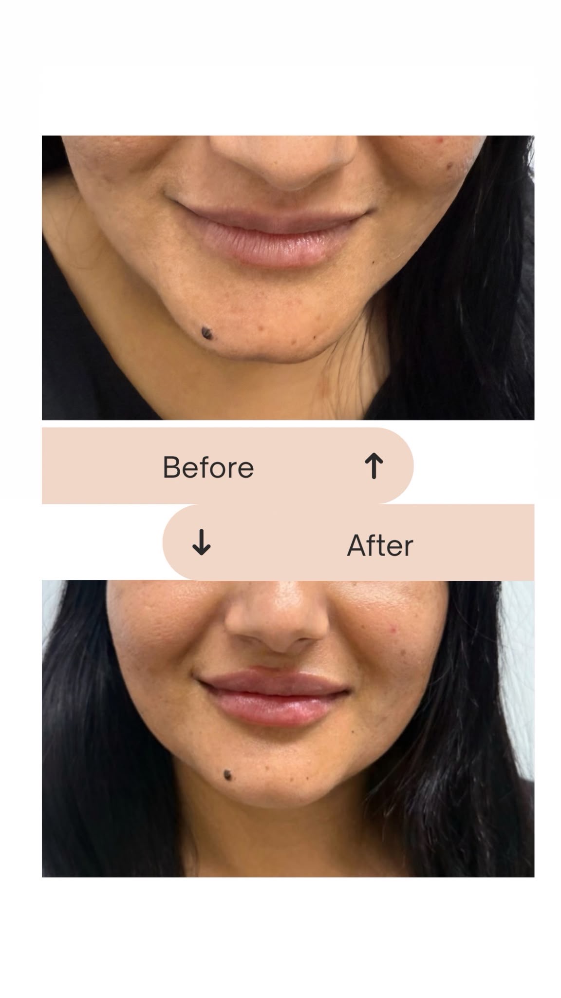 Lip treatment result